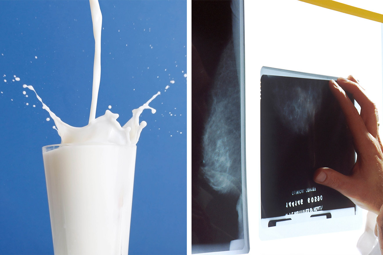Studie zeigt: Kuhmilch erhöht Risiko für Brustkrebs um bis zu 80 %