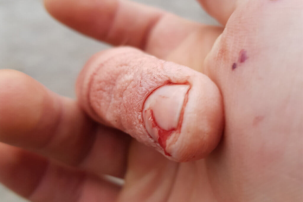 Verletzter Finger eines Mitarbeiters einer Pelzfarm